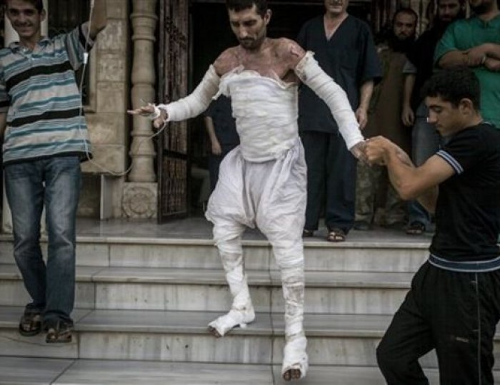 A Syrian man with more than half his body burnt from an air strike leaves a field hospital to go back home at a village turned into a battlefield with government forces in Idlib province, northern Syria, Sept. 22, 2013. This image was chosen by the Associated Press as one of the top 10 news photos representing the top stories of 2013. (AP Photo/Narciso Contreras, File)