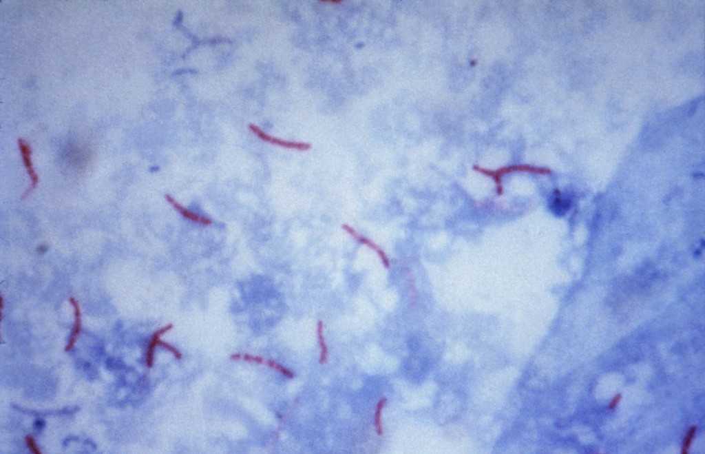 Mycobacterium_tuberculosis_Ziehl-Neelsen_stain_02